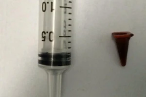 Mổ ung thư, thấy đồ chơi lỡ nuốt ... 40 năm trước