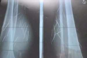 70 cây đinh tự trồi ra khỏi chân 1 phụ nữ