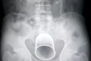 Nghe lời lang băm, nhét cốc vào mông chữa... dạ dày