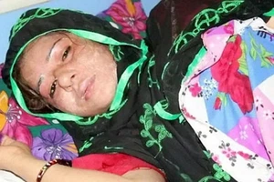 Chồng tạt acid vợ vì không sinh được con trai