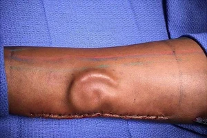 Hiếm: Tai 'mọc' trong... cánh tay cô gái 