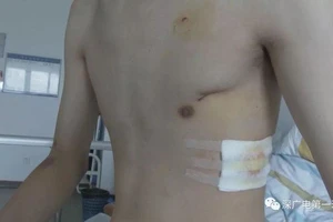 Tập thể dục cũng gây tràn khí màng phổi