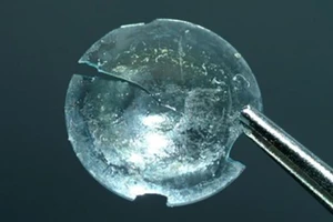 Tìm thấy kính áp tròng thất lạc trong mí mắt sau 28 năm