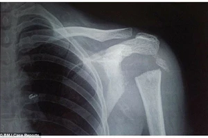 Người phụ nữ có khả năng xoay tay 180 độ sau khi mắc bệnh lạ