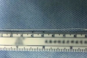 Phát hiện sán dài 10cm, sống khỏe trong não bệnh nhân