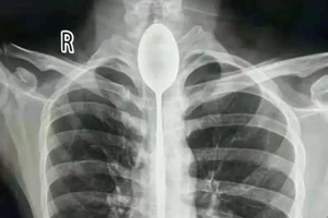 Mắc kẹt thìa dài 20 cm trong thực quản suốt 1 năm