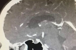 Khối u não bỗng dưng biến mất kỳ lạ trước ngày phẫu thuật