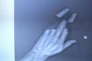 Người đàn ông mất 3 ngón tay vì thả diều