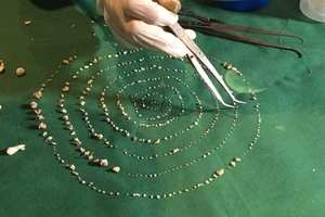 Kỳ lạ bé 7 tuổi có 526 chiếc răng