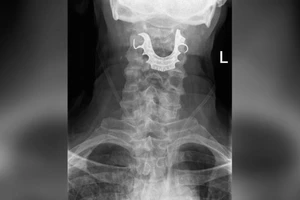 Bác sĩ làm rơi răng giả trong bụng cụ ông 72 tuổi suốt 8 ngày