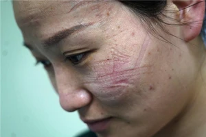 Vết khẩu trang hằn trên mặt một y tá đang chống dịch tại Vũ Hán. Ảnh: CHINA DAILY