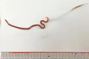 Con giun được lấy ra khỏi amidan cô gái. Ảnh: CNN