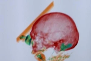 Máy quét phát hiện xương người trong hành lý của người phụ nữ Armenia. Ảnh: DPA/SCMP