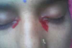 Kỳ lạ cô gái khóc ra máu mỗi tháng một lần