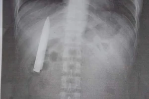 Lưỡi dao kẹt trong ngực gần năm trời mà không hay biết