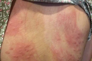 Đà Nẵng: Lấy mẫu nước, truy nguyên nhân gây ngứa sau tắm biển