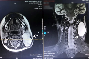 Khối u nằm ở vị trí nguy hiểm