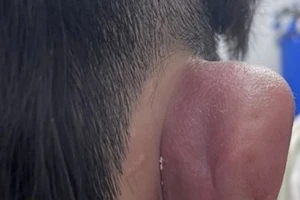 Nhiễm trùng, hoại tử vành tai do xỏ khuyên tai