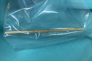 Nuốt tăm tre 10cm, người đàn ông bị đâm thủng đại tràng