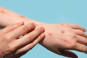 Nhiều người nhiễm HIV bị dính thêm đậu mùa khỉ