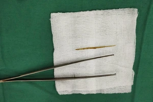Thủng ruột non do nuốt tăm tre