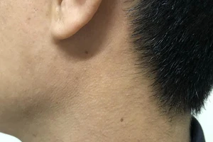 Đi khám do triệu chứng nuốt nghẹn, bất ngờ phát hiện ung thư thực quản