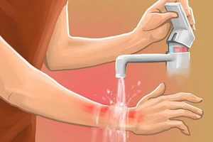 Ngâm con trong thùng nước lạnh để chữa bỏng khiến trẻ bị sốc nhiệt