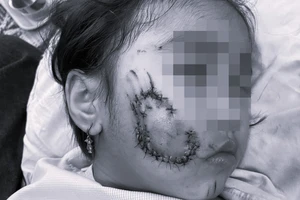 Bé gái 5 tuổi bị chó cắn phải khâu gần 50 mũi trên mặt