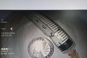 Bé 6 tuổi nuốt đồng xu vào thực quản