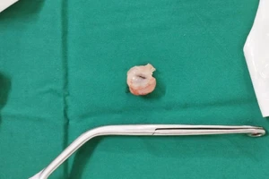 Hóc quả nhãn, bé gái 5 tuổi suýt ngừng tim