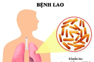 Mỗi năm khoảng 13.000 người tử vong do bệnh lao, nhiều người giấu bệnh, mặc cảm