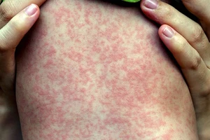 Hà Nội: Ca mắc rubella đầu tiên trong năm 2024 đã tiêm vaccine phòng bệnh