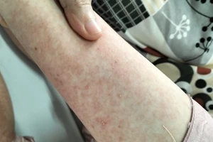 Nổi mụn mủ toàn thân do căn bệnh 100.000 người mới có 1 người mắc