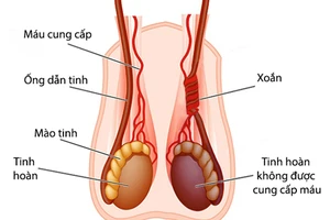 Bé trai 28 ngày tuổi bị xoắn tinh hoàn, phải cắt bỏ toàn bộ