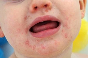 Tay chân miệng tăng gấp 5 lần cùng kỳ, phía Nam chiếm gần 72%