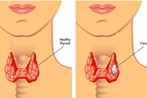Bị ung thư di căn ở tuổi 24