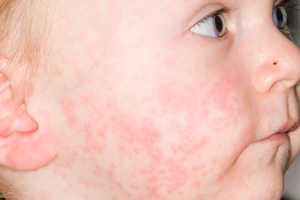 Tại sao nhiều trẻ tiêm đủ 2 mũi vaccine sởi vẫn mắc bệnh?