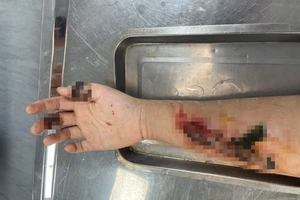 Suýt hoại tử cánh tay vì đắp lá cây vào vết thương