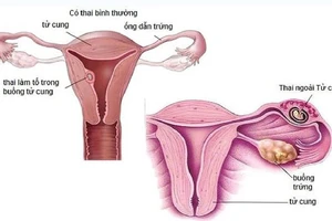 Suýt tử vong do dùng thuốc phá thai tại nhà