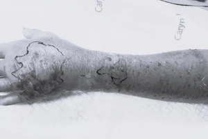 Bị trẻ 3 tuổi cắn, người đàn ông sốt cao nhập viện