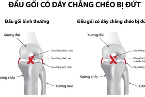 Sau 20 năm bị ngã mới biết mình bị đứt dây chằng khớp gối