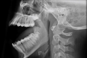 Thanh niên 27 tuổi trật khớp hàm vì… ngáp