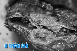 Người phụ nữ được chẩn đoán u thận do miếng gạc nằm trong bụng suốt 14 năm 