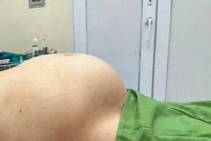 Khối u buồng trứng to như thai 8 tháng