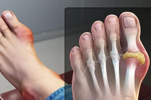 Người bệnh gút nên ăn gì ngày Tết?