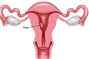 Bé 14 tuổi mắc đa polyp buồng tử cung ở phụ nữ trưởng thành