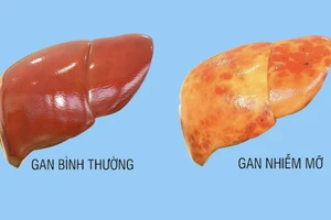 Những cách giúp ngăn ngừa gan nhiễm mỡ