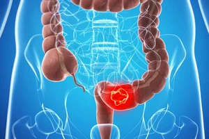 8 dấu hiệu cảnh báo sớm ung thư đại trực tràng