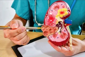 Ăn gì để chữa bệnh sỏi thận?