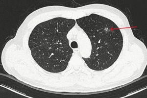 Nhờ AI, bác sĩ phát hiện bệnh nhân mắc ung thư phổi giai đoạn rất sớm